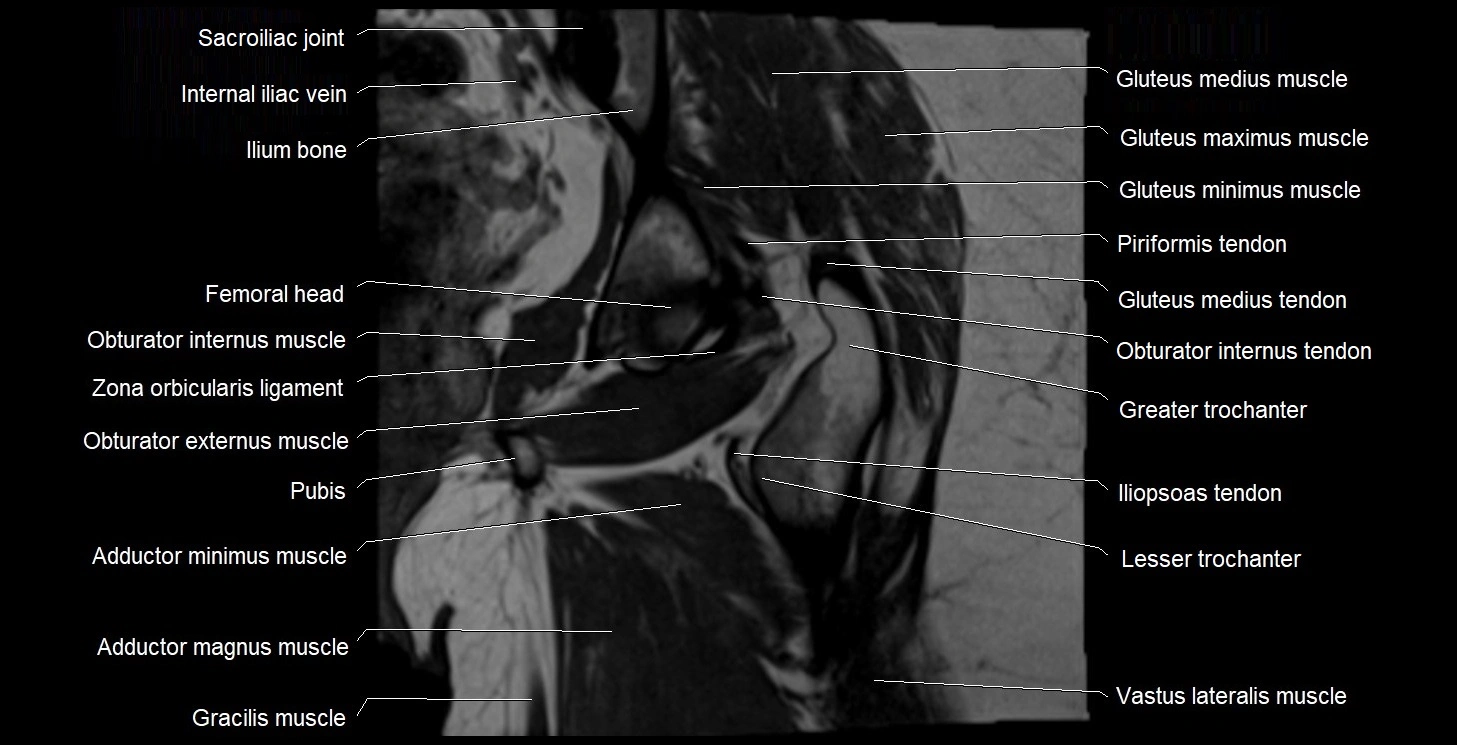 MRI Hip 3T coronal cross sectional anatomy image 40.webp